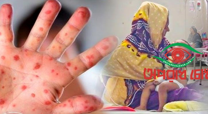 উদ্বেগজনকভাবে বাড়ছে হামের রোগী