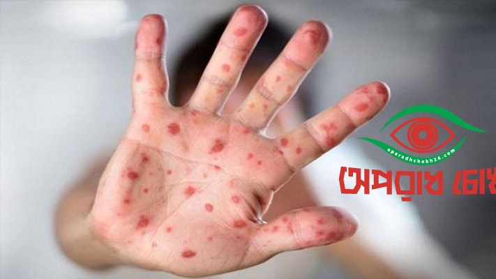 হামের ঝুঁকিতে গর্ভবতী নারীরাও